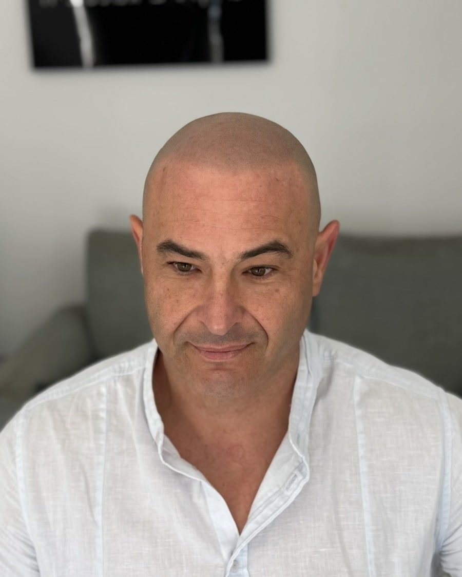 אלכסיי אחרי הדמיית שיער בסקאלפ
