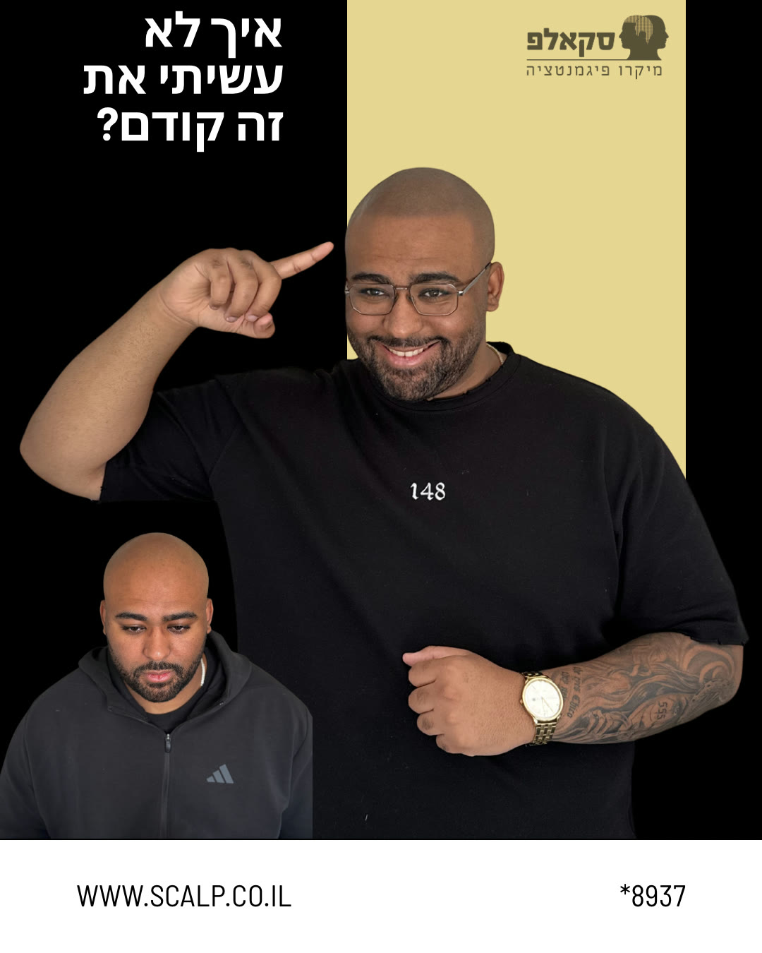 לפני ואחרי הדמיית שיער בסקאלפ: איך לא עשיתי את זה קודם